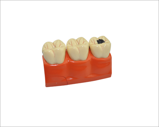 Model of decayed teeth