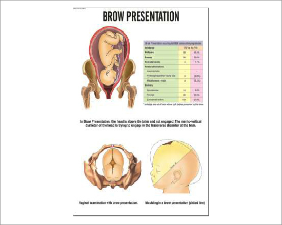 Brow Presentation Chart