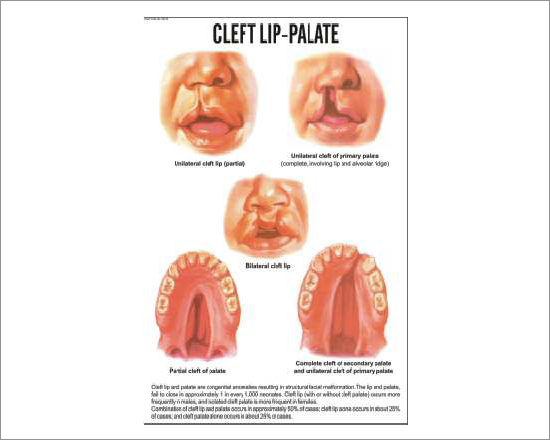 Cleft lip Palate Chart