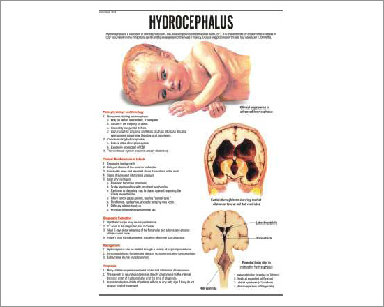 Hydrocephalus Chart