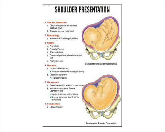 Shoulder Presentation Chart