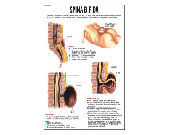 Spina Bifida Chart